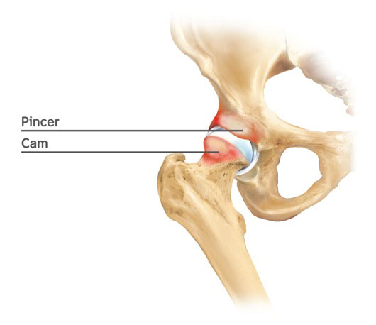 Therapy Guide to Impingement (Femoroacetabular Impingement) - Carousel Physical Therapy